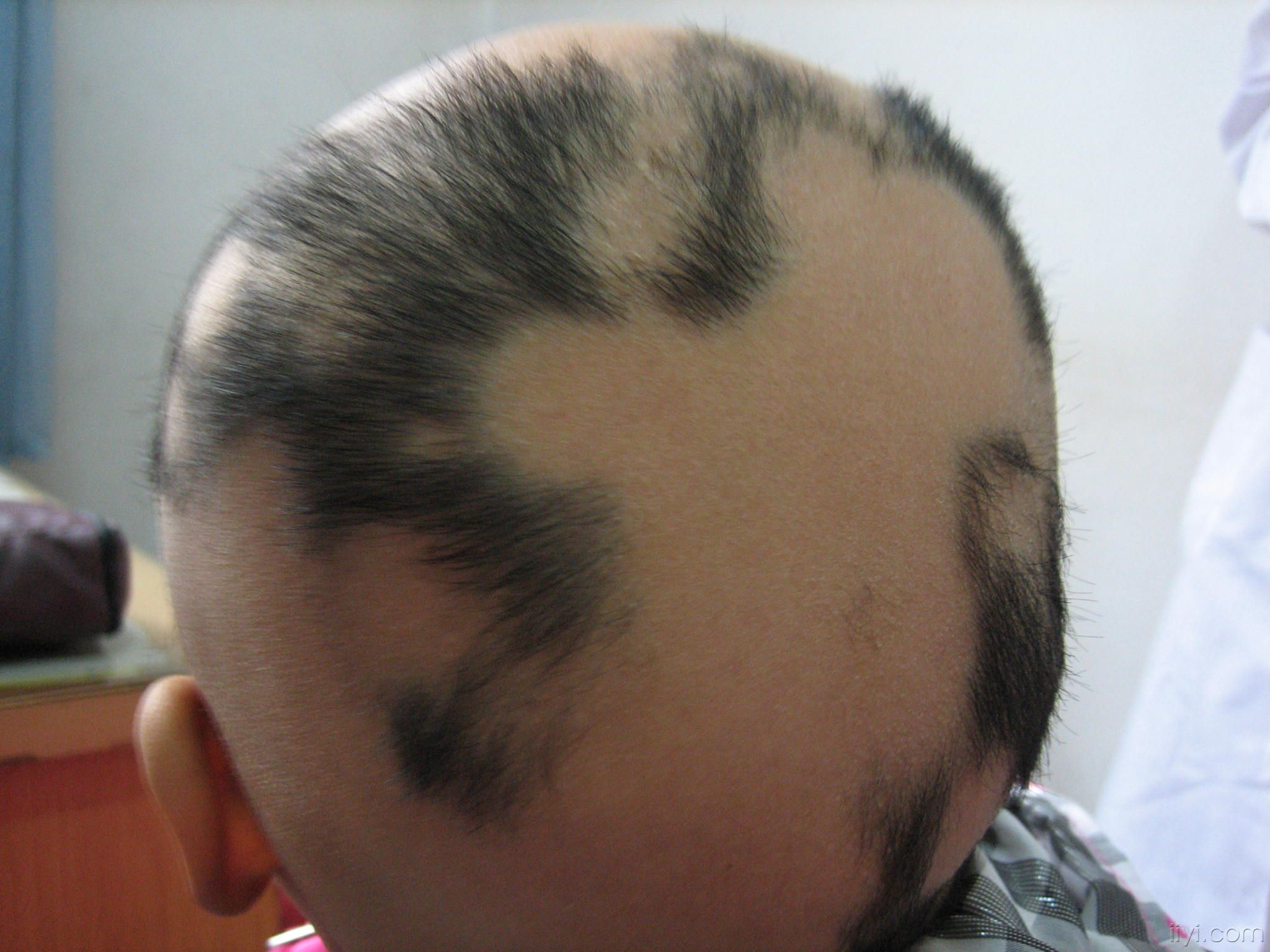 冬虫夏草对斑秃的治疗作用